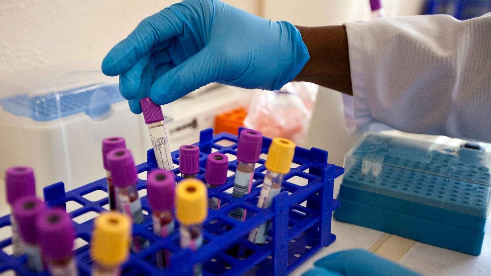 image for 5th person confirmed to be cured of HIV