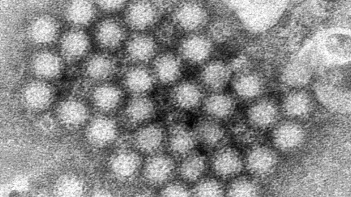 image for Norovirus cases are surging in parts of the US, CDC data shows