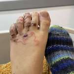 image for I was in the Hospital because one Parasite was eating my foot from the inside 🪱
