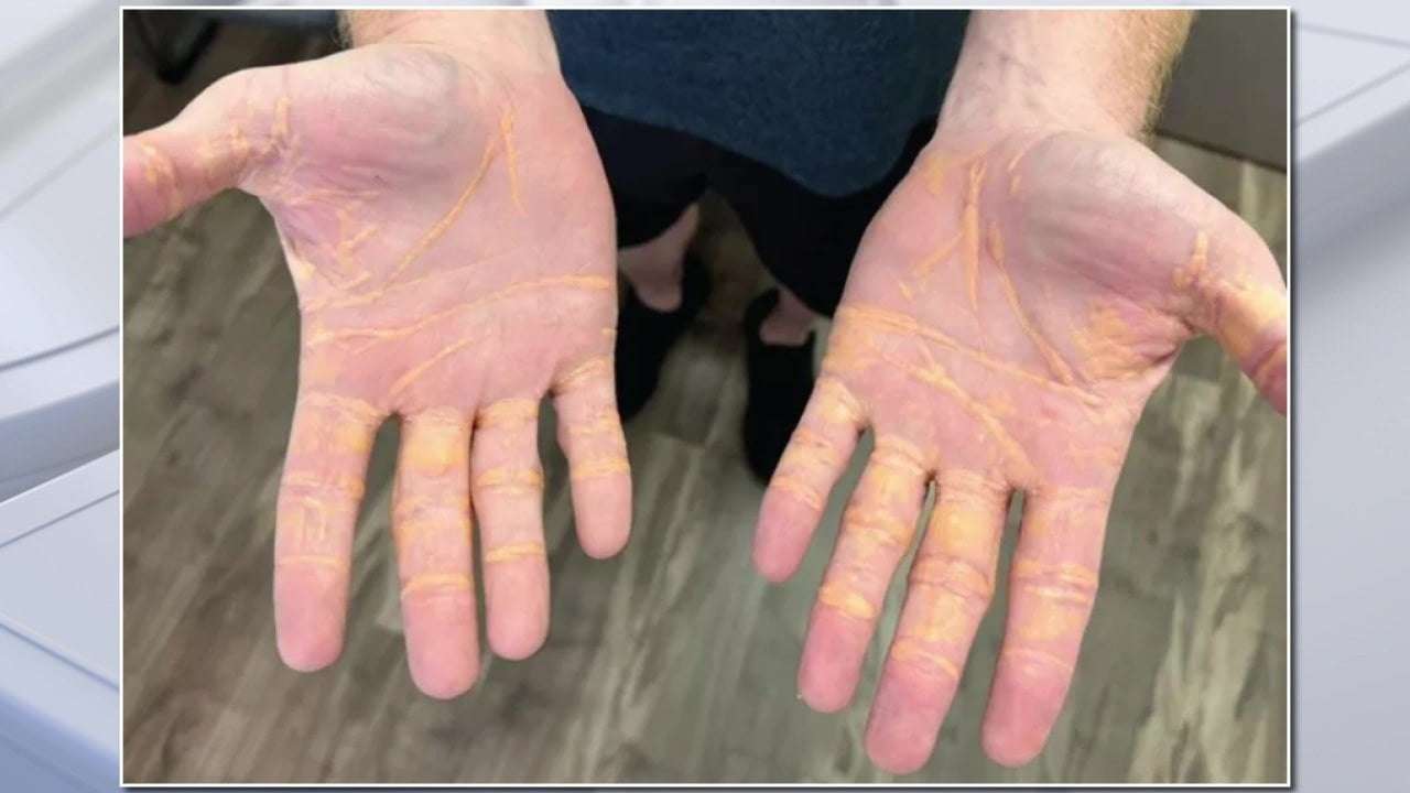 image for Man eating 6-9 pounds of butter and cheese a day develops ‘cholesterol hands’ while on carnivore diet: JAMA
