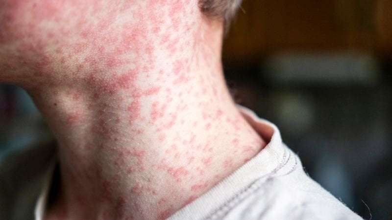 image for Measles outbreak expands in West Texas around county with low vaccination rate