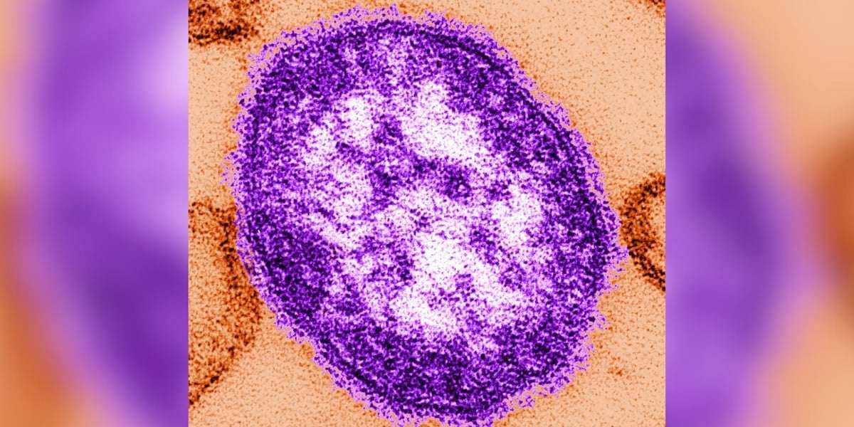 image for Measles case confirmed in Kentucky