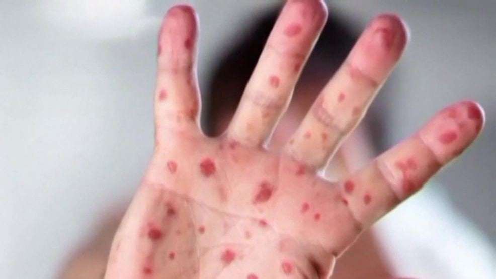 image for Case of German measles confirmed in San Antonio at Legacy Traditional School