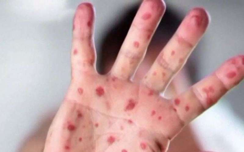 image for Case of German measles confirmed in San Antonio at Legacy Traditional School