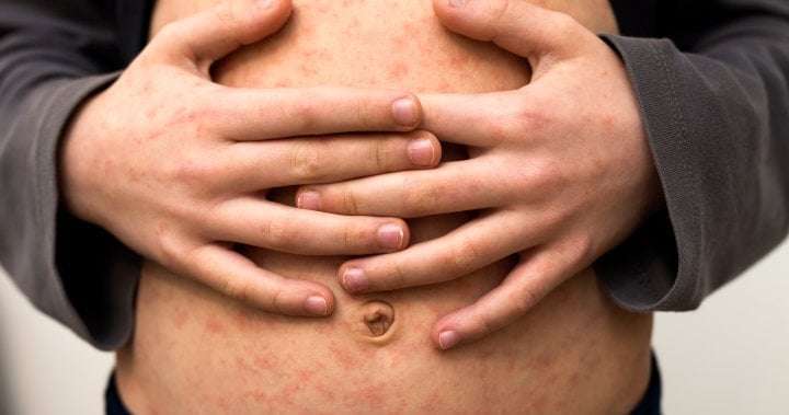 image for Parents are holding ‘measles parties’ in the U.S., alarming health experts - National