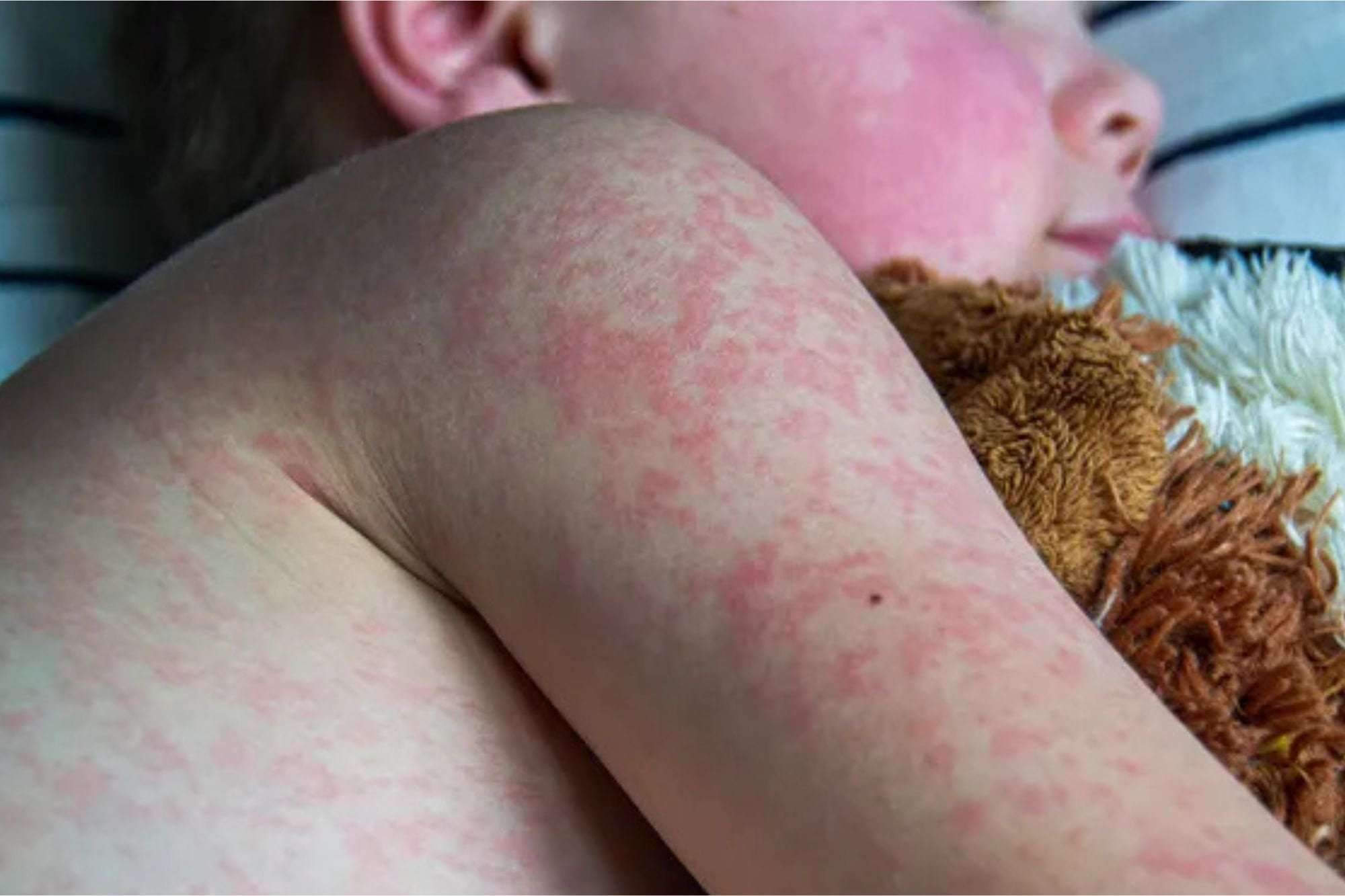 image for Anti-Vaxx Mom Whose Daughter Died From Measles Says Disease 'Wasn't That Bad'