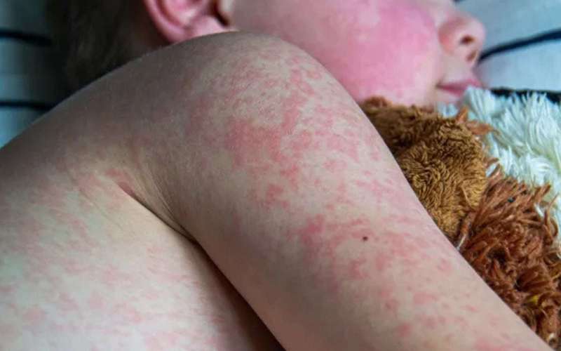 image for Anti-Vaxx Mom Whose Daughter Died From Measles Says Disease 'Wasn't That Bad'
