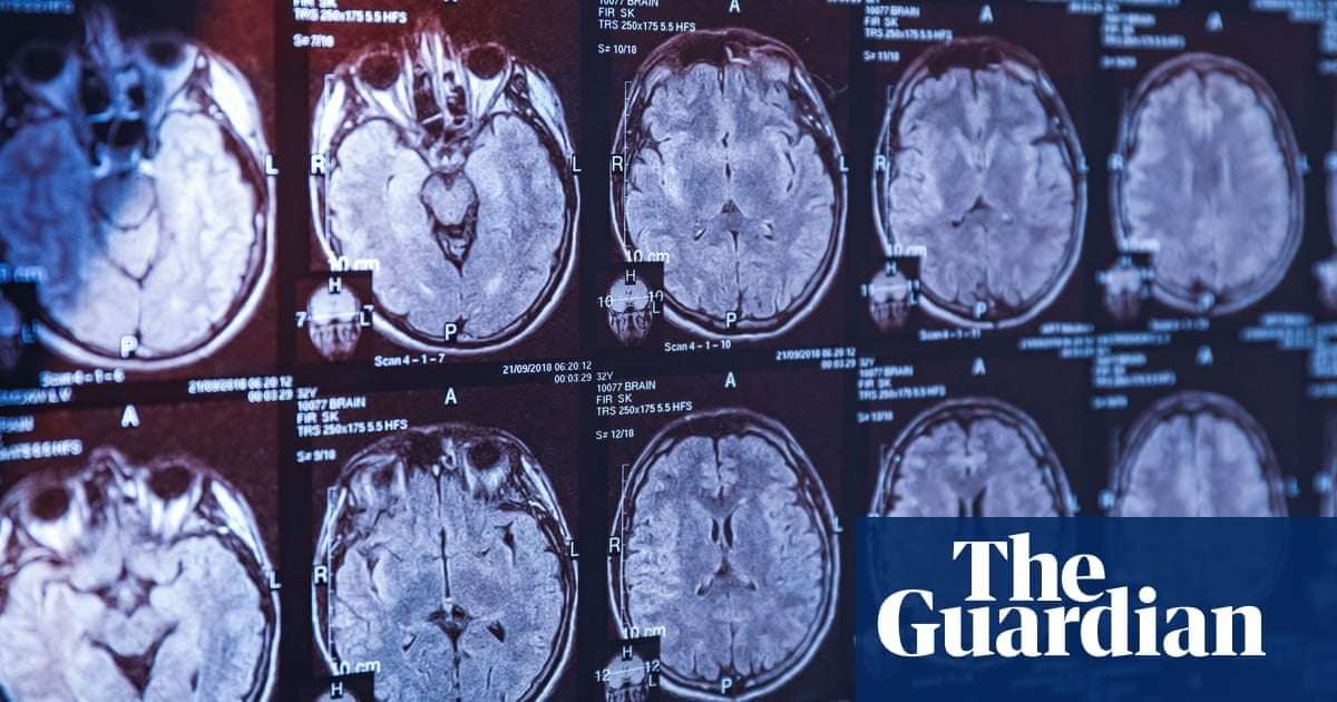 image for Blood test could detect Parkinson’s disease before symptoms emerge