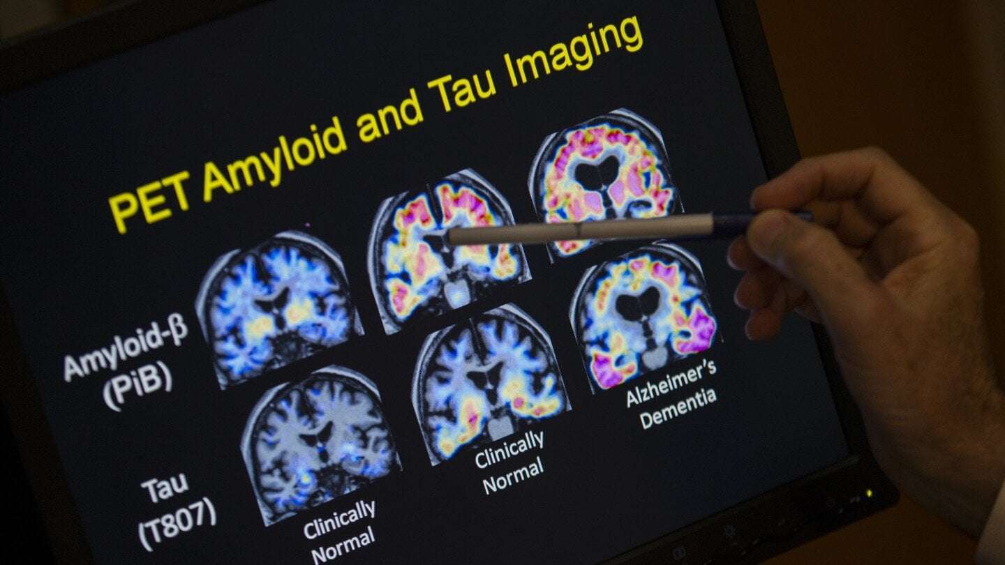 image for FDA OKs first blood test that can help diagnose Alzheimer’s disease