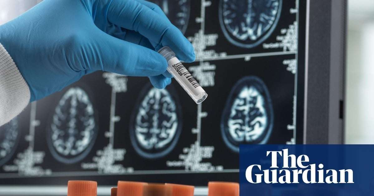 image for Alzheimer’s blood test can spot people with early symptoms, study suggests