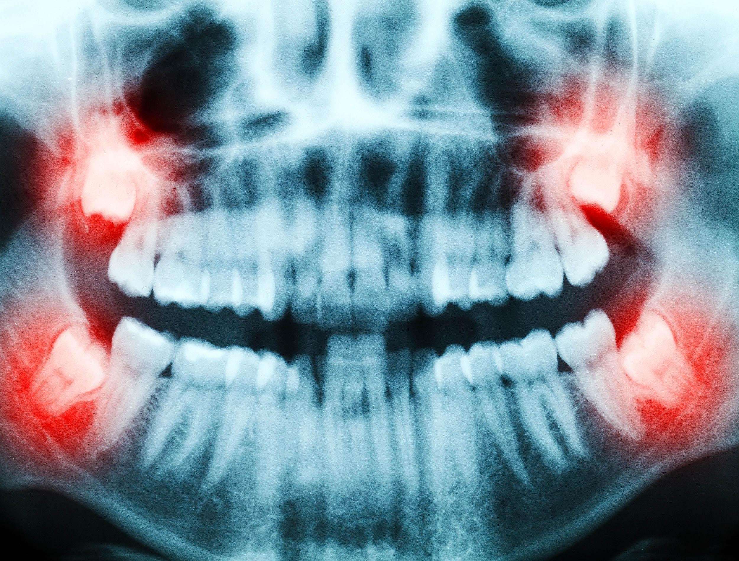 image for Stem cells from extracted wisdom teeth are like "medical gold," able to treat multiple diseases