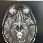 image for Brain mass - cavernoma removed 2021 after I had a seizure in front of my neurosurgery preceptor.