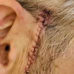 image for 5 de scar! brain tumor induced seizures while driving, cops had guns on me,  broke my back
