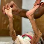image for Legs of 5 month old Zeinab Abu Halib at the time of her death due to starvation in Gaza (CNN)