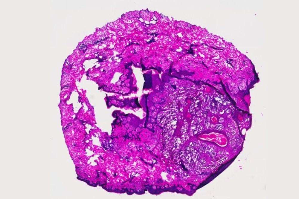 image for Immunotherapy drug eliminates aggressive cancers in clinical trial - Of 12 patients, 6 patients saw their tumors shrink, including 2 who saw them disappear completely. The 12 patients had a variety of metastatic cancer types: melanoma, renal cell carcinoma, and different types of breast cancer.