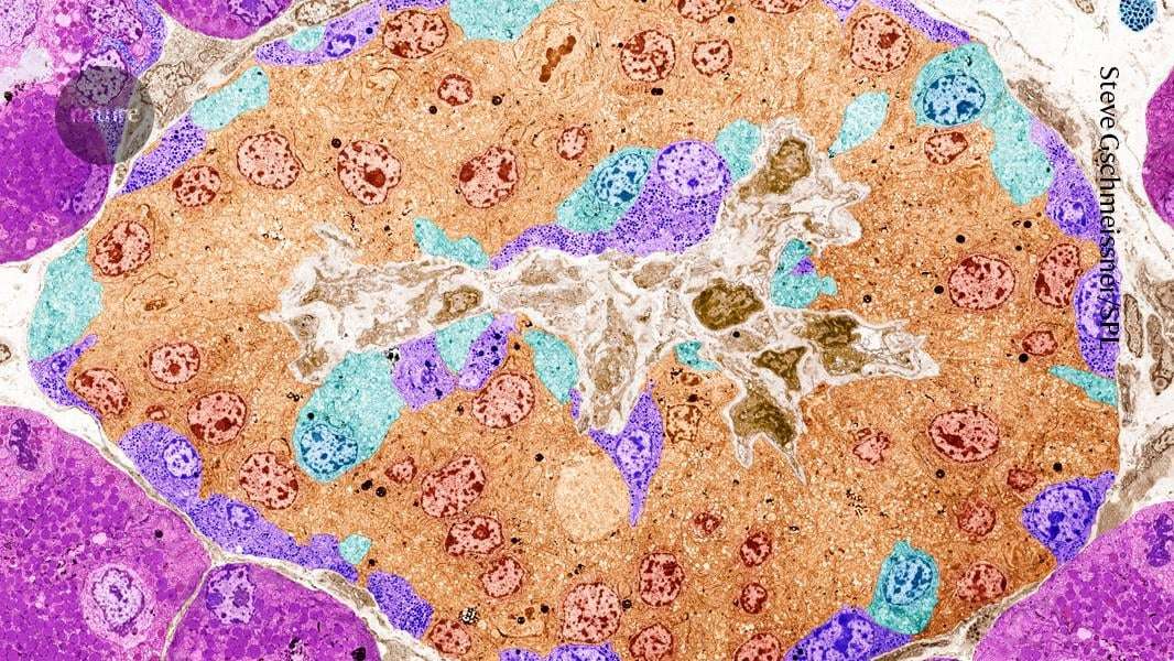 image for Hope for diabetes: CRISPR-edited cells pump out insulin in a person – and evade immune detection