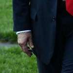 image for Trump's hand looking bruised and discolored today