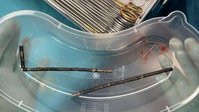 image for “He Ate Up to 100 Magnets” Doctors Stunned After 13-Year-Old Loses Part of His Bowel