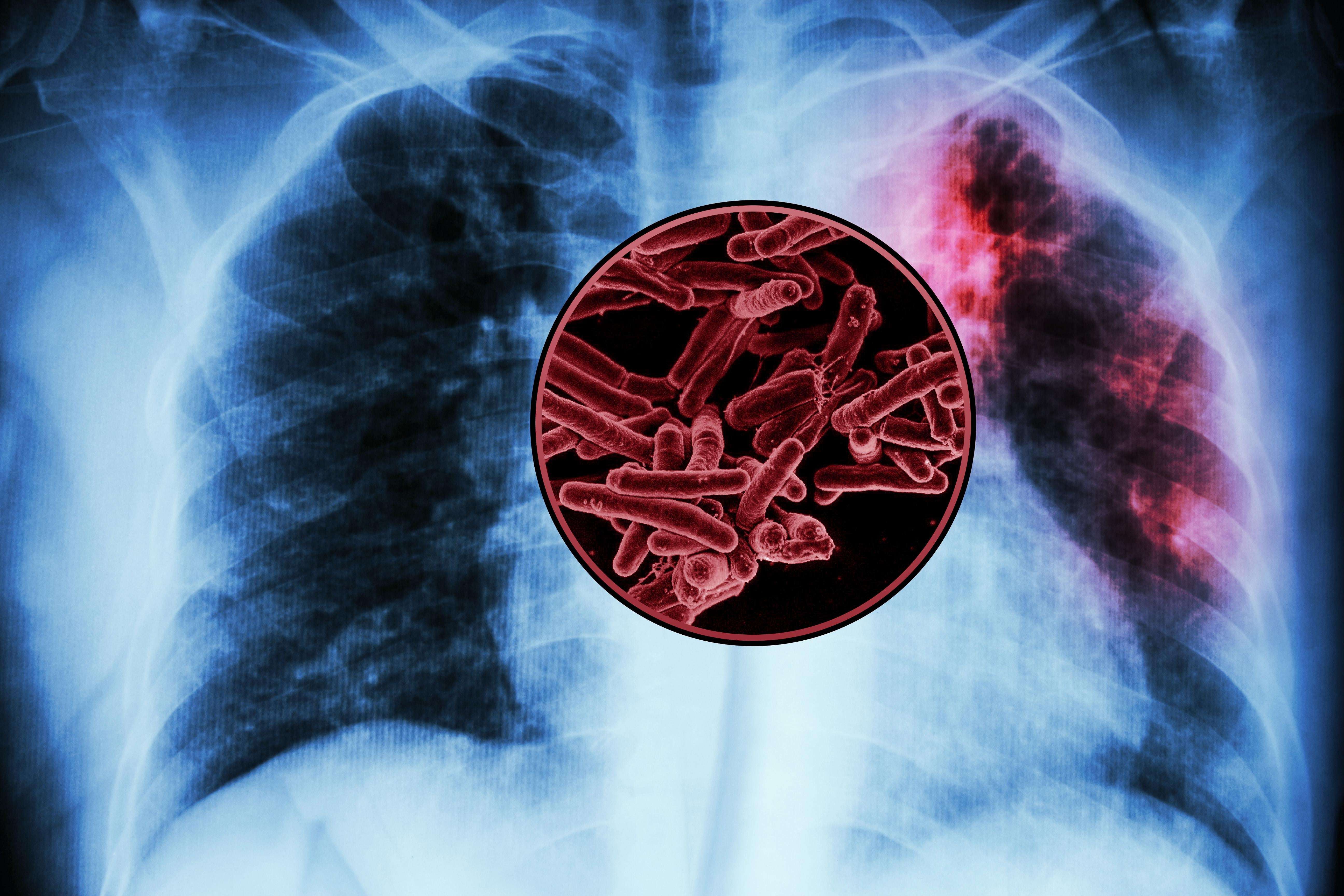image for MIT study finds targets for a new tuberculosis vaccine