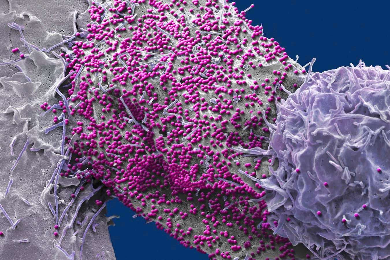 image for Man unexpectedly cured of HIV after stem cell transplant