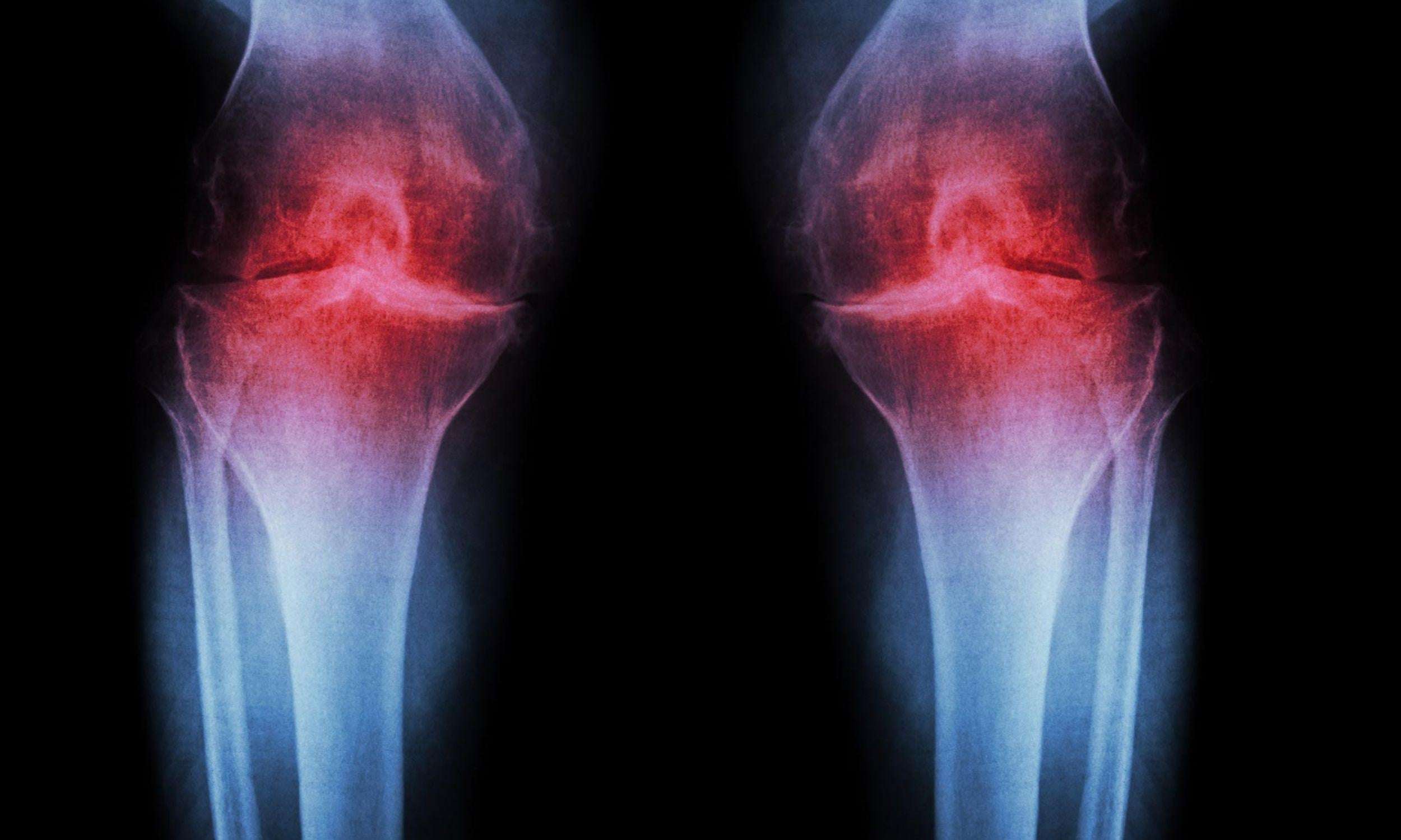 image for Scientists restore knee cartilage using targeted injection