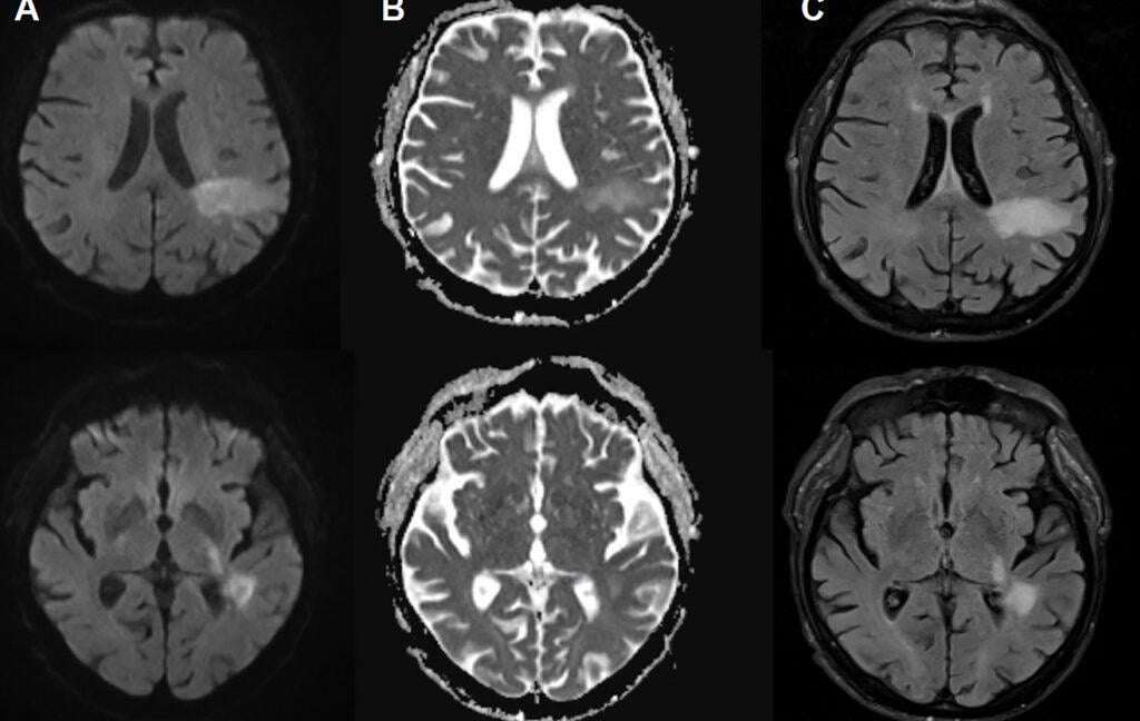 image for You’re likely already infected with a brain-eating virus you’ve never heard of