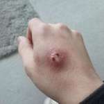image for [OC] Got bit by a spider a few days ago