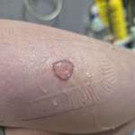 image for (OC) Black Widow Bite 3 Days Post Bite - OTC X3 Antibiotic, HOCL + Hydrocolloid Bandage