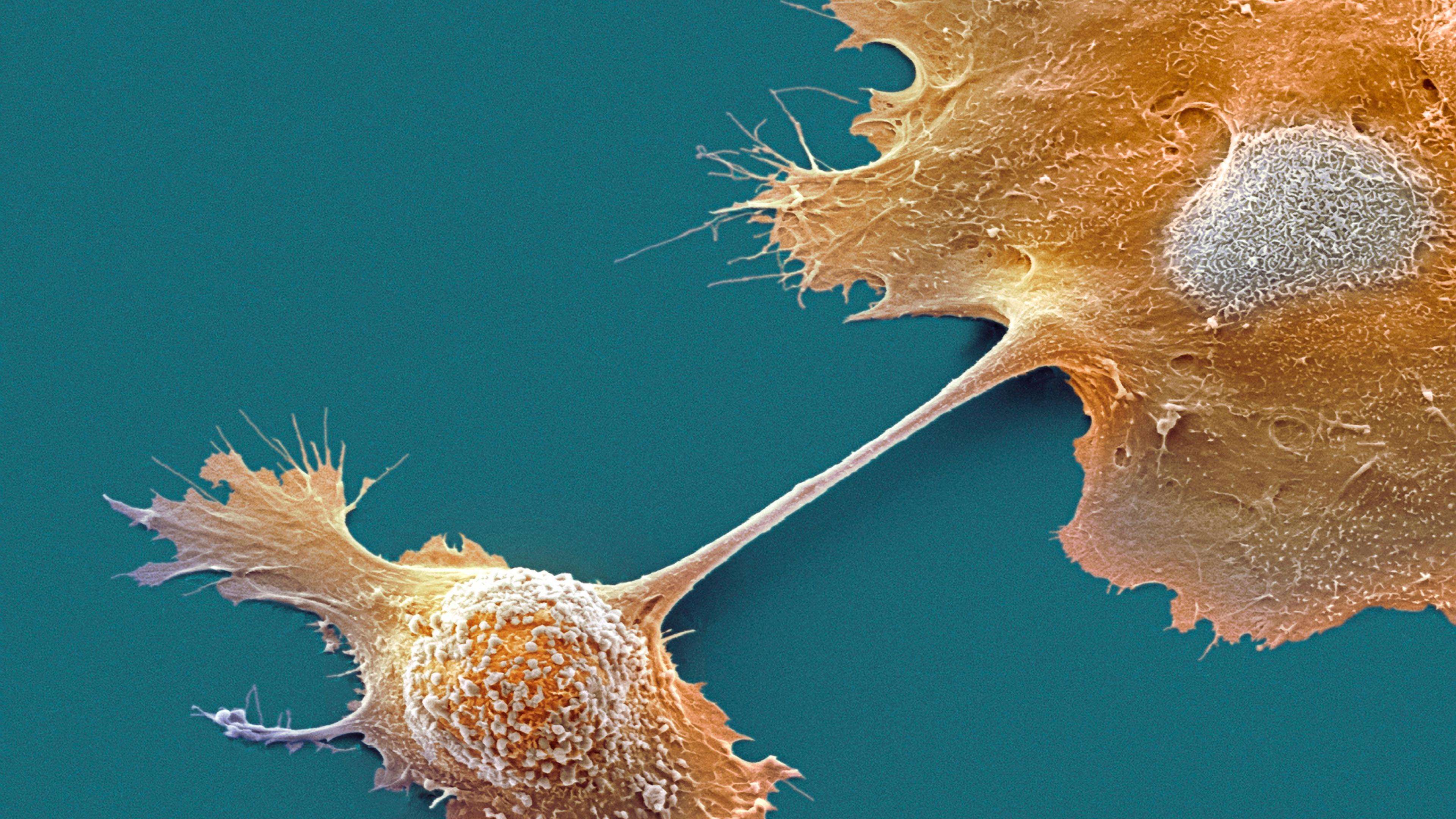 image for Two New Drugs Offer Hope for Pancreatic Cancer