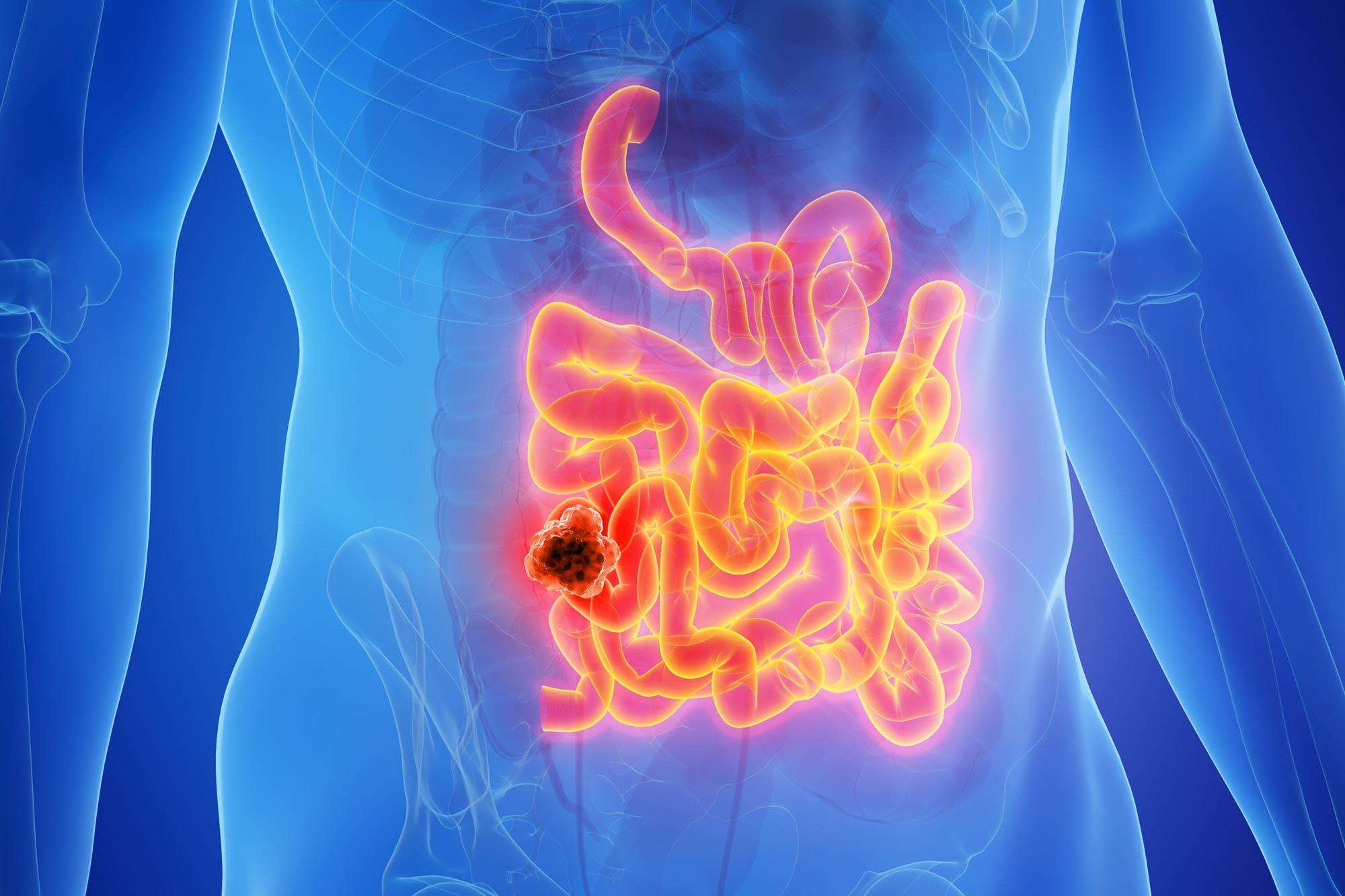 image for Breakthrough Bowel Cancer Trial Leaves Patients Cancer-Free for Nearly 3 Years