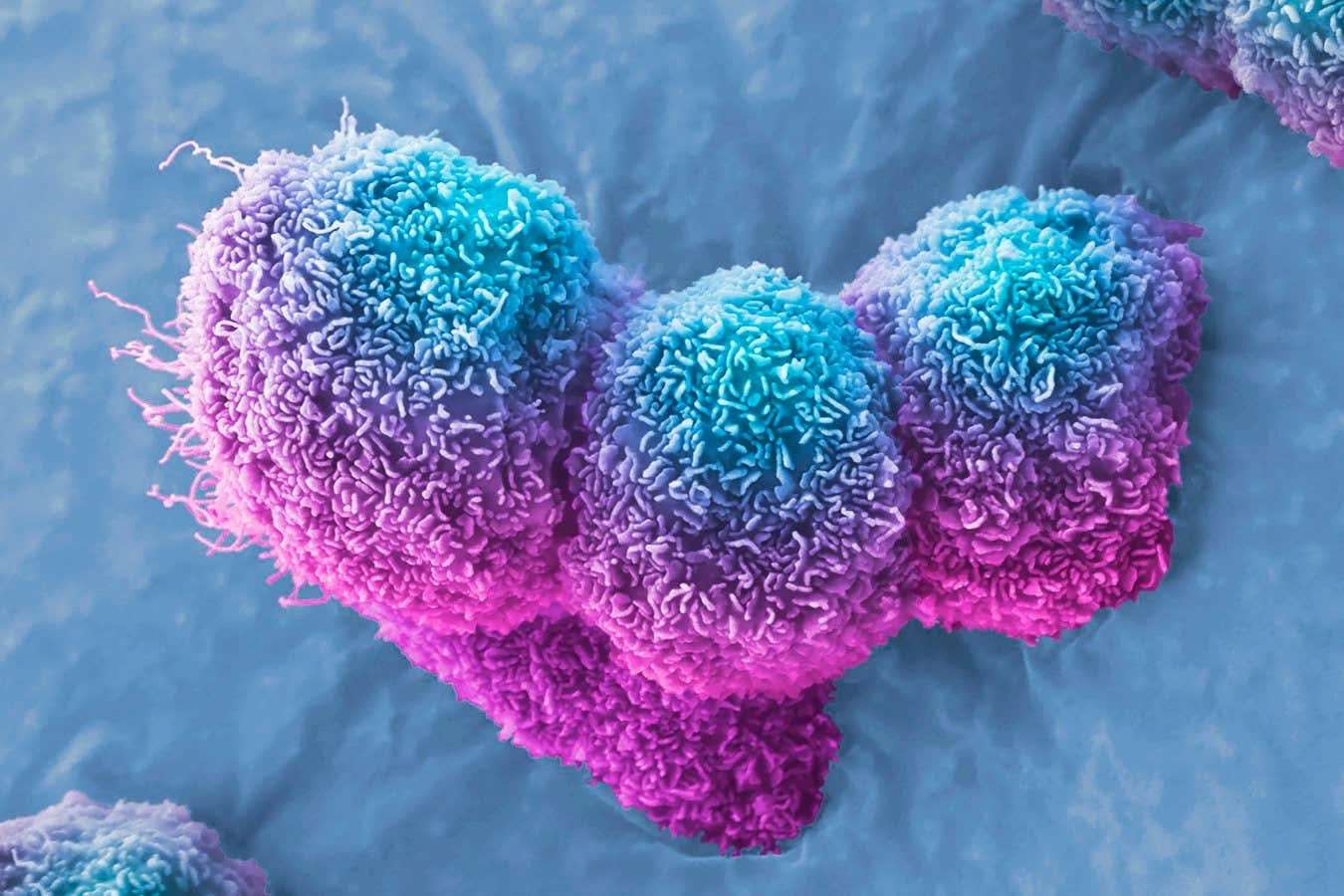 image for Pancreatic cancer halted by virus injection in three patients