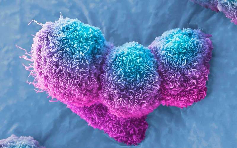 image for Pancreatic cancer halted by virus injection in three patients