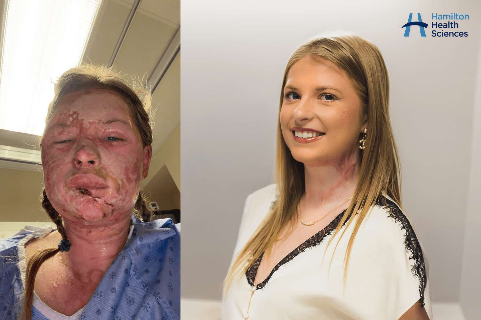 image for World-first burn treatment with “absolutely remarkable” results performed at leading Canadian hospital