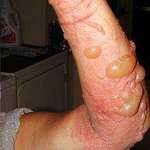 image for Don't burn poison ivy; some people are extremely allergic.
